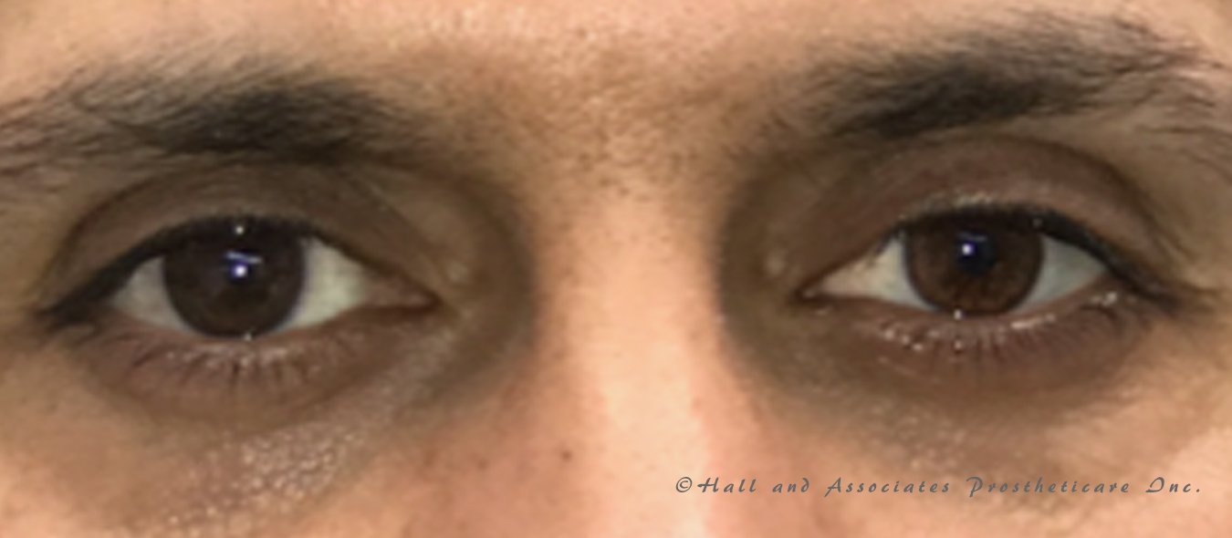 Ocular Prosthetics – Advanced Prosthetics and Orthotics